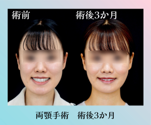 【骨切り】両顎手術 術後3か月