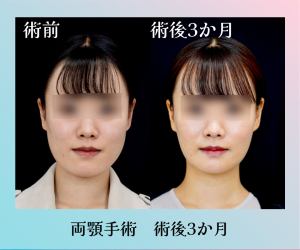 【骨切り】両顎手術 術後3か月
