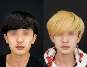 輪郭3点施術した男性の術後3ヶ月後の正面を向いた写真。