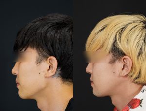 輪郭3点施術した男性の術後3ヶ月後の左横を向いた写真。
