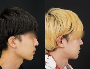 輪郭3点施術した男性の術後3ヶ月後の右横を向いた写真。