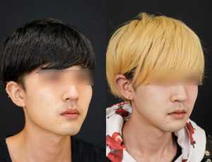 輪郭3点施術した男性の術後3ヶ月後の斜め右を向いた写真。