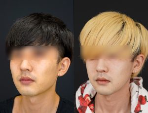 輪郭3点施術した男性の術後3ヶ月後の斜め左を向いた写真。