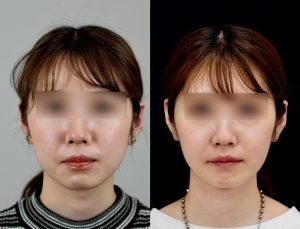 顎矯正施術(両顎手術)を受けたの方の６か月後の正面の症例写真。