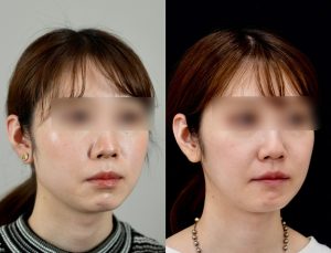顎矯正施術(両顎手術)を受けたの方の６か月後の右斜めを向いた症例写真。