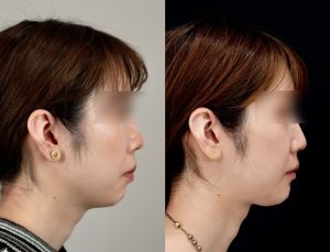 顎矯正施術(両顎手術)を受けたの方の６か月後の右横を向いた症例写真。