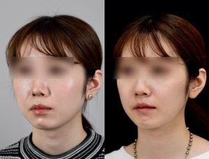 顎矯正施術(両顎手術)を受けたの方の６か月後の左斜めを向いた症例写真。