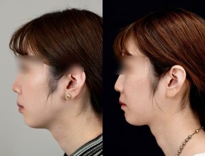 顎矯正施術(両顎手術)を受けたの方の６か月後の左横を向いた症例写真。