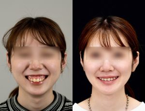 顎矯正施術(両顎手術)を受けたの方の６か月後の正面で笑った時の症例写真。