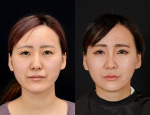 顎矯正施術(両顎手術)を受けたの方の６か月後の正面の症例写真。