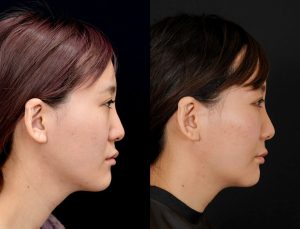 顎矯正施術(両顎手術)を受けたの方の６か月後の右横の症例写真。