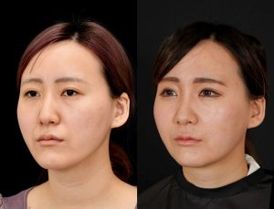 顎矯正施術(両顎手術)を受けたの方の６か月後の左斜めの症例写真。