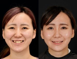顎矯正施術(両顎手術)を受けたの方の６か月後の正面で笑った時の症例写真。