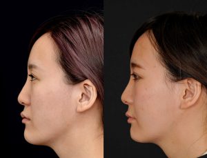 顎矯正施術(両顎手術)を受けたの方の６か月後の左横の症例写真。