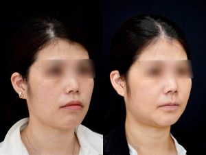 顎矯正施術（両顎手術）を受けた3ヶ月後の方の右斜めの症例写真です。