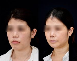 顎矯正施術（両顎手術）を受けた3ヶ月後の方の左斜めの症例写真です。