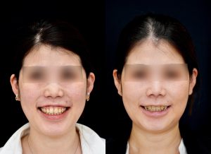 顎矯正施術（両顎手術）を受けた3ヶ月後の方の笑った時の症例写真です。
