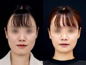 顎矯正施術（両顎手術）を受けた6ヶ月後の方の正面の症例写真です。