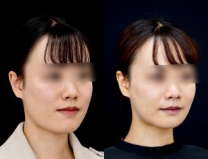 顎矯正施術（両顎手術）を受けた6ヶ月後の方の右斜めの症例写真です。