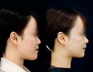 顎矯正施術（両顎手術）を受けた6ヶ月後の方の右横の症例写真です。