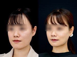 顎矯正施術（両顎手術）を受けた6ヶ月後の方の左斜めの症例写真です。