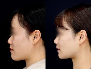 顎矯正施術（両顎手術）を受けた6ヶ月後の方の左横の症例写真です。