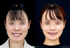 顎矯正施術（両顎手術）を受けた6ヶ月後の方の笑った時の症例写真です。