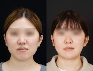輪郭3点+脂肪吸引を受けたの方の3ヶ月後の正面を向いた症例写真。