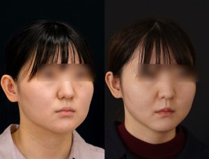 顎矯正施術(両顎手術)を受けた方の１年後の右斜めの症例写真。