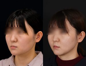 顎矯正施術(両顎手術)を受けた方の１年後の左斜めの症例写真。