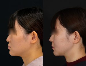 顎矯正施術(両顎手術)を受けた方の１年後の左横の症例写真。