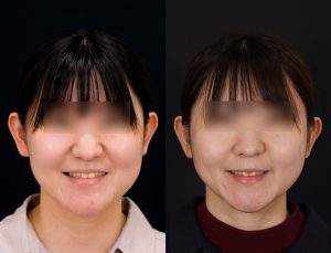 顎矯正施術(両顎手術)を受けた方の１年後の正面で笑った時の症例写真。