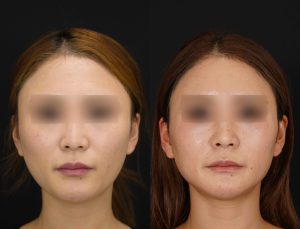 輪郭3点を施術した方の術後１ヶ月後の正面を症例写真。