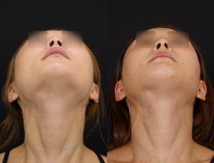 輪郭3点を施術した方の術後１ヶ月後の上を向いた時の症例写真。