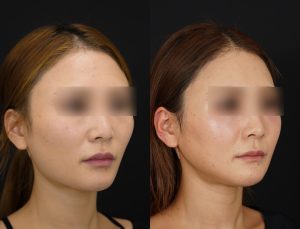 輪郭3点を施術した方の術後１ヶ月後の右斜めの症例写真。