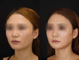 輪郭3点を施術した方の術後１ヶ月後の左斜めの症例写真。