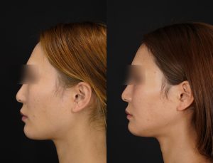 輪郭3点を施術した方の術後１ヶ月後の左横の症例写真。