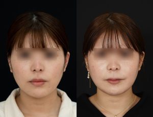 顎矯正施術(両顎手術)を受けた方の１年後の正面の症例写真。