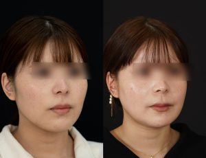 顎矯正施術(両顎手術)を受けた方の１年後の右斜めの症例写真。