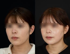顎矯正施術(両顎手術)を受けた方の１年後の左斜めの症例写真。