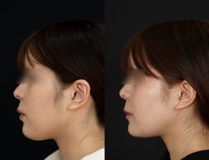 顎矯正施術(両顎手術)を受けた方の１年後の左横の症例写真。