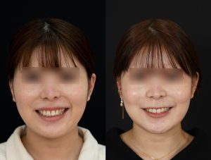 顎矯正施術(両顎手術)を受けた方の１年後の笑った時の症例写真。