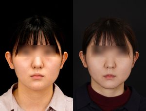 顎矯正施術(両顎手術)を受けた方の１年後の正面の症例写真。