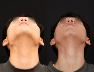 輪郭2点(エラ＋頬骨)を受けたの方の３ヶ月後の上を向いた症例写真。