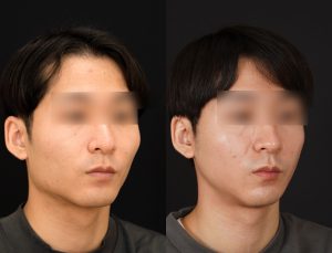 輪郭2点(エラ＋頬骨)を受けたの方の３ヶ月後の斜め右を向いた症例写真。