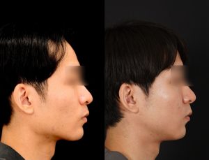 輪郭2点(エラ＋頬骨)を受けたの方の３ヶ月後の右横を向いた症例写真。