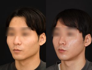輪郭2点(エラ＋頬骨)を受けたの方の３ヶ月後の斜め左を向いた症例写真。