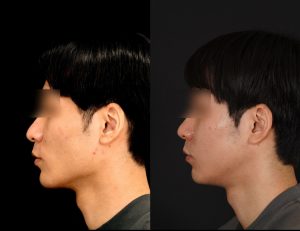 輪郭2点(エラ＋頬骨)を受けたの方の３ヶ月後の左横を向いた症例写真。