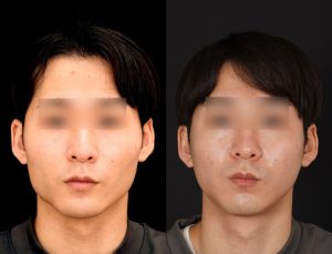 輪郭2点(エラ＋頬骨)を受けたの方の３ヶ月後の正面を向いた症例写真。