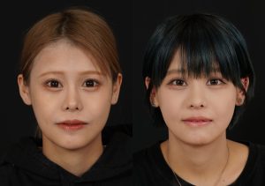 他院輪郭３点後の両顎手術で立体感のある小顔に。鼻の他院修正も行っています。